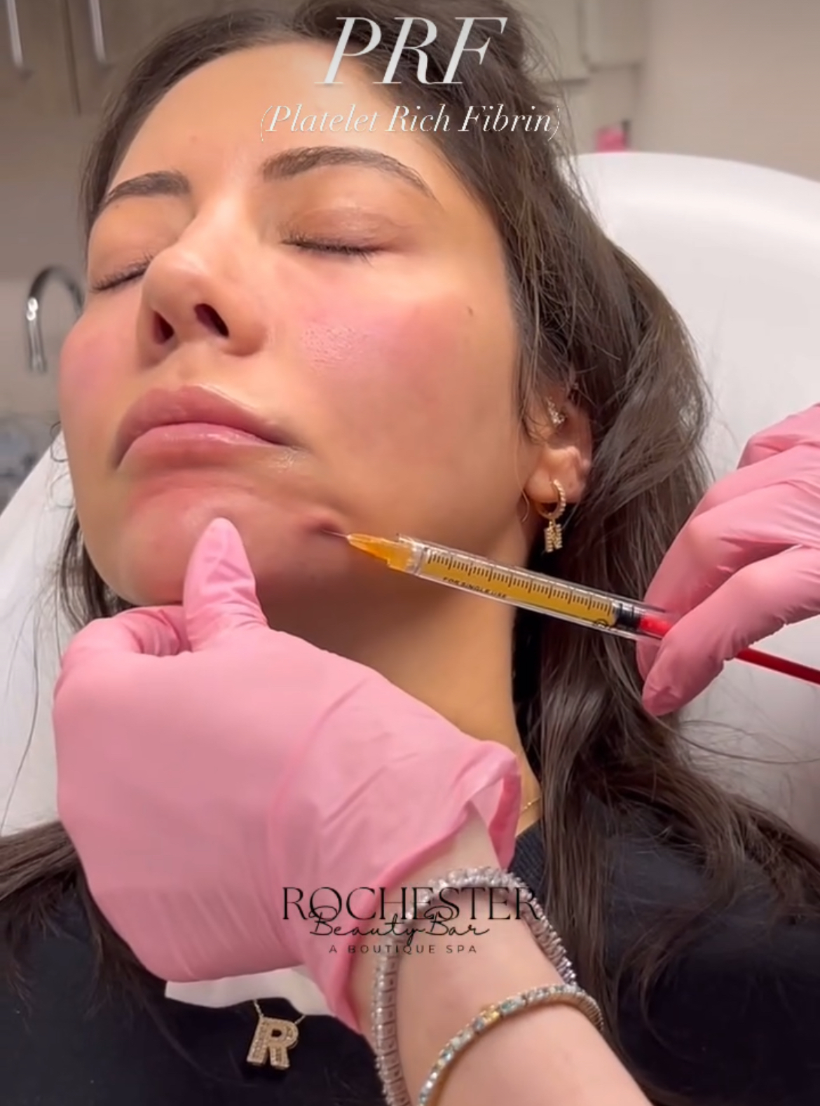 PRF Platelet-Rich Fibrin/EZ Gel in Rochester, MI – Rochester Beauty Bar