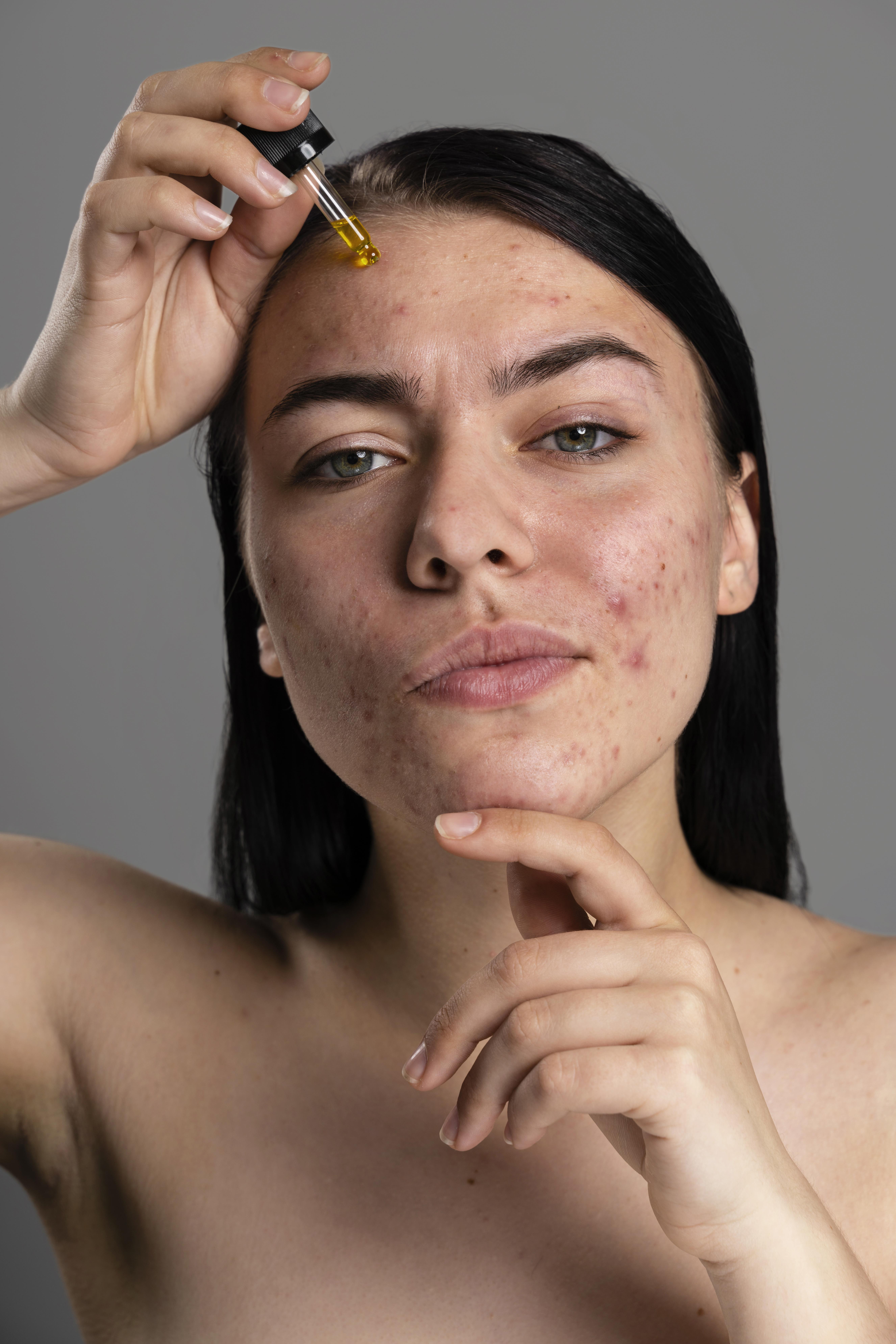 How to Treat Acne in Adults: Tips and Treatments from Rochester Beauty Bar
